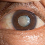cataract web