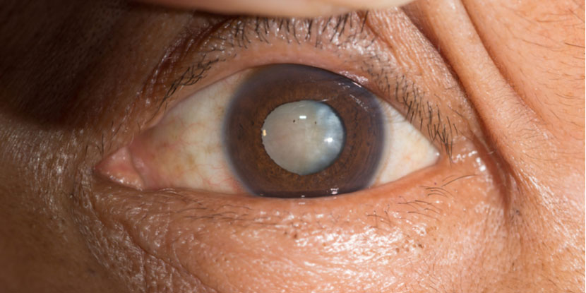 cataract web