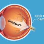 glaucoma pressure 330x220 1 150x150 1