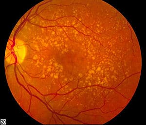 300px Intermediate age related macular degeneration